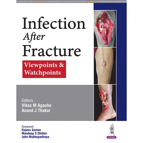 Infection After Fracture: Viewpoints & Watchpoints by Vikas M Agashe, 1st Edition